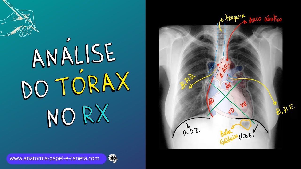 Aprenda a analisar o exame de TÓRAX no RX