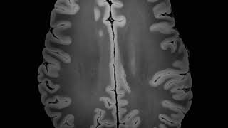 100 micron MRI scan of the human brain