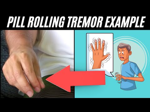 Pill rolling tremor - Parkinson's Disease example