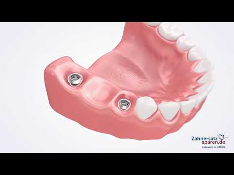 Behandlungsablauf: Brücke auf Implantaten  Zahnersatzsparen.de
