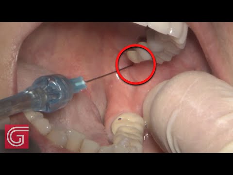 How to Give a GOW GATES Dental Injection for Beginners