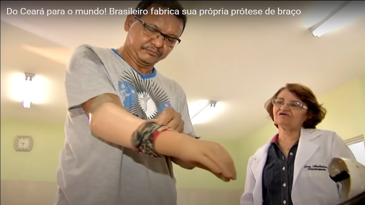 Do Ceará para o mundo! Brasileiro fabrica sua própria prótese de braço