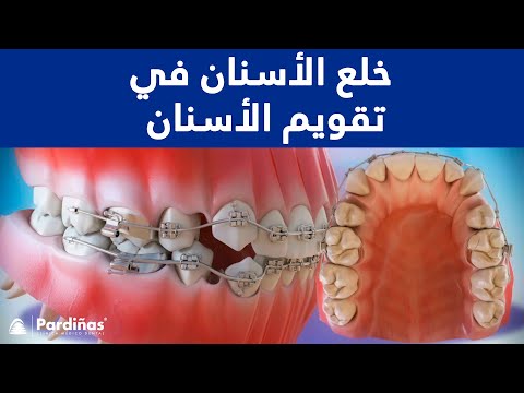 خلع الأسنان في تقويم الأسنان ©