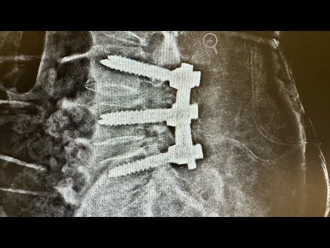 How much spine surgery is safe? | Dr. Ajay Kothari