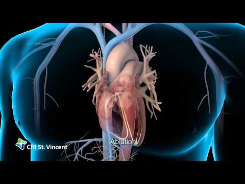 Thumbnail for Atrial Fibrillation Explained — How It Happens and How It's Treated
