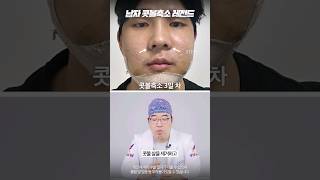콧볼축소술 성형 시술
