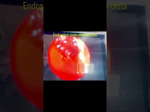 Endoscopic Evaluation of Clots