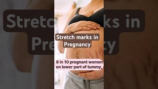 The Secrets for Removing Pregnancy Stretch Marks | Dr RITU | Aaतman #skincare #pregnancytips