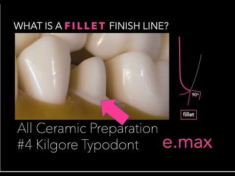 All Ceramic Crown Preparation for Lithium Disilicate #4 KILGORE