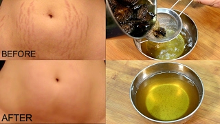 Get Rid Of Stretch Marks In 30 Days/ Stretch Marks Removal *Simple Beauty Secrets*