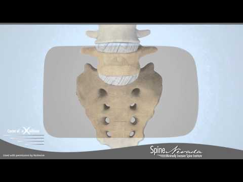 Minimally Invasive Anterior Lumbar Interbody Fusion - Reno, Sparks, Carson, Northern Nevada