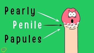 Pearly Penile Papules (PPP) 10 Facts about Pearly Penile Papules