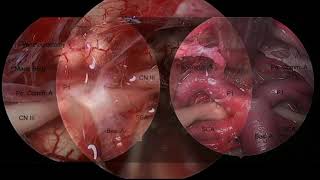 Endoscopic endonasal approach for brainstem cavernous malformation