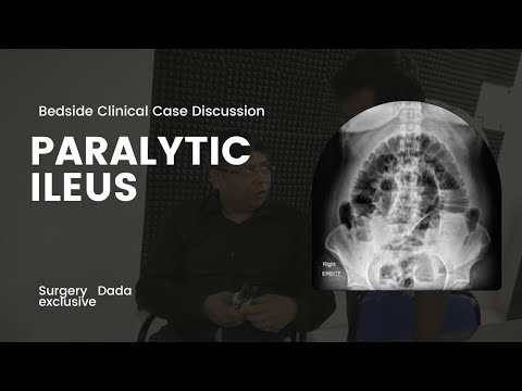 Paralytic Ileus || Presentation, evaluation and management ||Clincalculable case discussion..