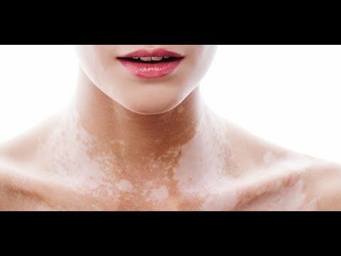 Decolorazione del lievito di persona Avene da posti di pigmentary