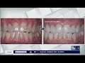 An easier fix for receding gums