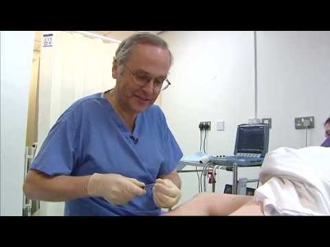 Foam sclerotherapy for varicose veins - a patient's view - Philip Coleridge Smith