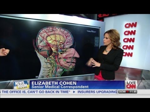 Explaining what a mini-stroke means