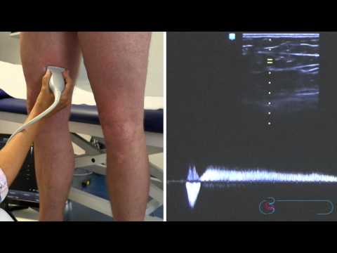 Varicose veins: Diagnosis with ultrasound 2
