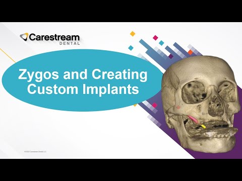 Zygos and Creating Custom Implants