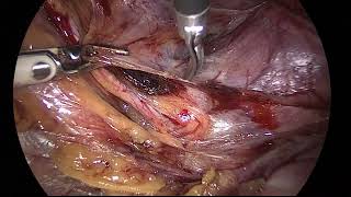 HemiHysterectomy (non comunicating horn) + Adenomyosis