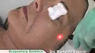 ACUPUNTURA ESTÉTICA CURITIBA - RUGAS FACIAIS