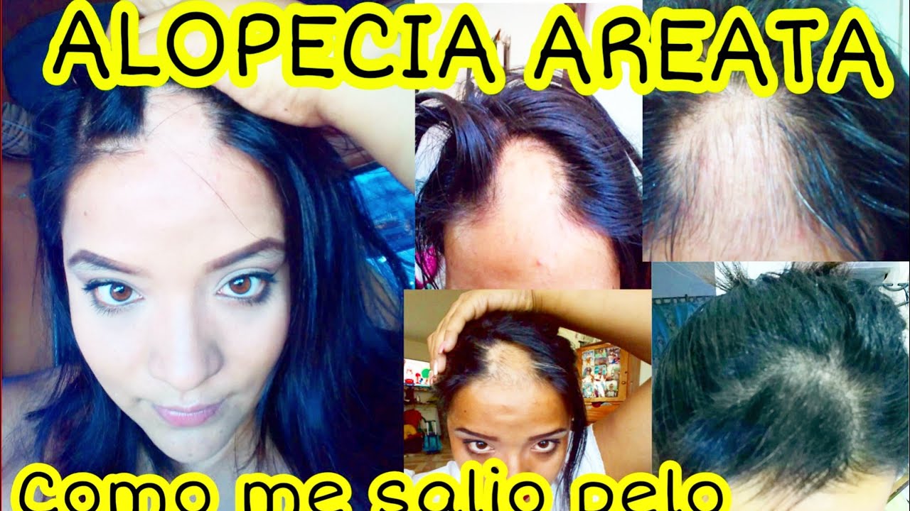 Watch Tengo alopecia Areata - como curar la alopecia - caida de cabello - calvicie - enfermedades Now Tengo alopecia Areata - como curar la alopecia - caida de cabello - calvicie - enfermedades