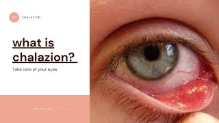 what is chalazion? Red bump on eyelid|symptoms |complications |Treatment