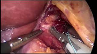 Versa Lifter Band - Partial Fundoplication