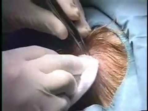 comment soigner kyste