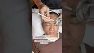 Acne Peel at DIVA Skin Clinic