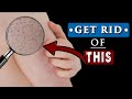 How to GET RID of WHITE BUMPS on ARMS? || KERATOSIS PILARIS