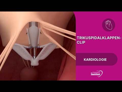 Trikuspidalklappen Clip - Minimalinvasive Behandlung der Trikuspidalinsuffizienz