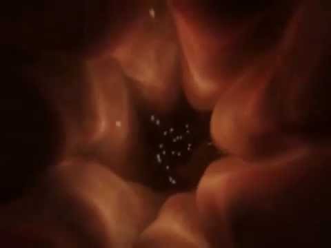 What is IUI? What is IUI Procedure?