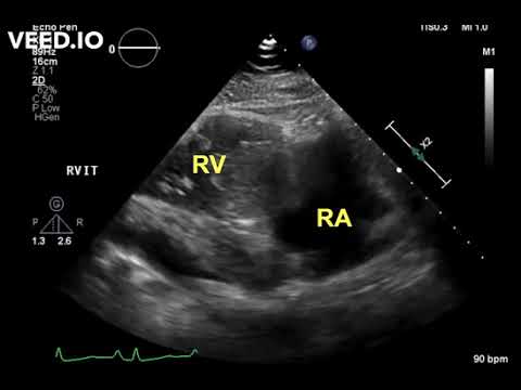 Large Right Atrial Myxoma Presenting As Bilateral Pulmonary Embolism