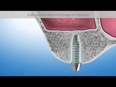 Podniesienie dna zatoki szczękowej.Odbudowa tkanki kostnej w zatoce szczękowej.