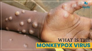 What is Monkeypox, Its Symptoms & Causes | Monkeypox Virus Hindi | Dr. Jatin @Apollo Hospitals 