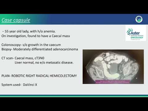 PIPAC — Minimally Invasive Chemotherapy