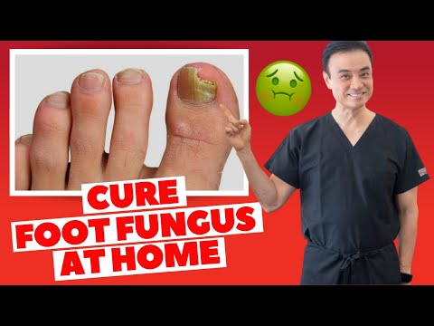 Soluție picior pentru ciuperca unghiilor