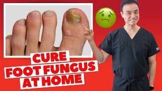 6 Effective HOME REMEDIES To CURE Toenail FUNGUS | Holistic Toenail Fungus Cures Part 2 | Dr. Kim