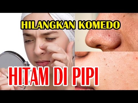 download lagu mp3 mp4 Cara Menghilangkan Komedo Hitam Di Pipi, download lagu Cara Menghilangkan Komedo Hitam Di Pipi gratis, unduh video klip Cara Menghilangkan Komedo Hitam Di Pipi