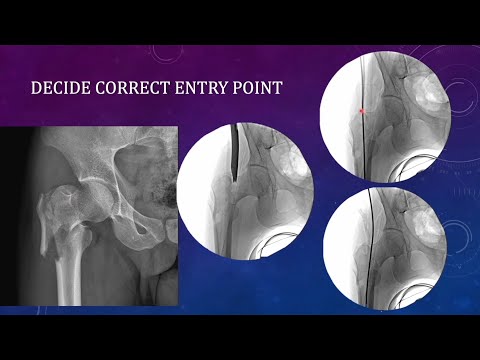 Basic technical tips for nailing of trochanteric /IT femur fractures