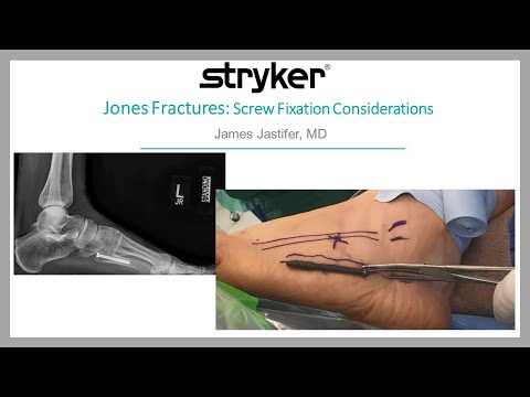 Jones Fractures-Screw Fixation Considerations