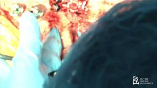 Live Demo: Vertebral Column Resection - Munish Gupta, MD