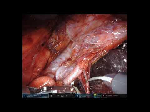 Robotic Partial Nephrectomy 