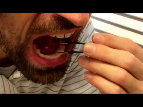 Removing my own salivary gland stone
