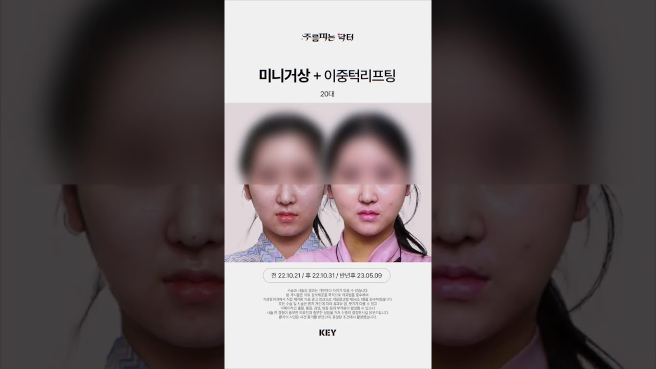 20대의 미니거상 미니리프팅 대구키성형외과