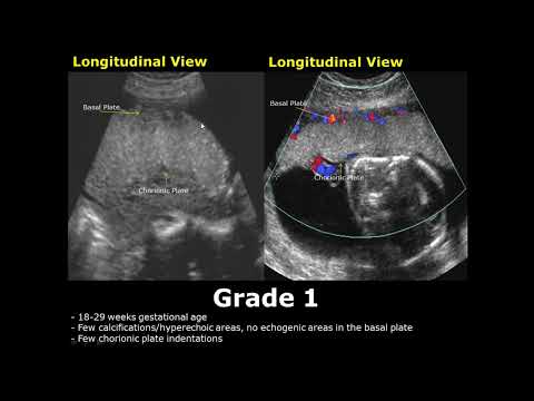 Placental Grading On Ultrasound | Grade 0, 1, 2, 3 Placenta USG