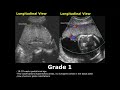 Placental Grading On Ultrasound | Grade 0, 1, 2, 3 Placenta USG