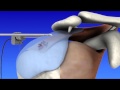 Shoulder Arthroscopy Shoulder Arthroscopy